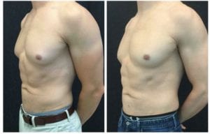 20504b-male-breast-reduction - Male Breast Reduction - Before And After - Gynecomastia - Fairfax and Manassas VA