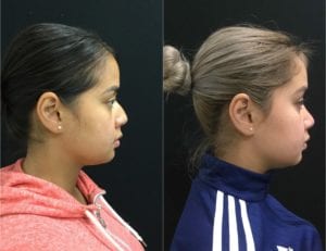 20529-20170314_-Side-Canvas-rhinoplasty-for-women - Rhinoplasty For Women - Before And After | Fairfax and Manassas VA
