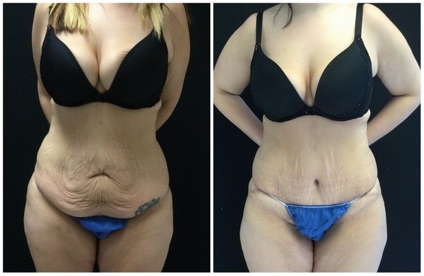 20712a-tummy-tuck-abdominoplasty - Tummy Tuck & Abdominoplasty - Before And After - Fairfax and Manassas VA