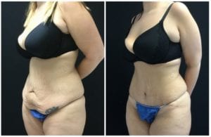 20712b-tummy-tuck-abdominoplasty - Tummy Tuck & Abdominoplasty - Before And After - Fairfax and Manassas VA