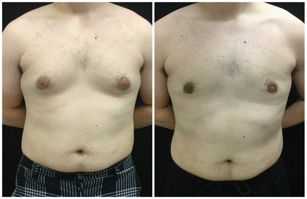 20939a-male-breast-reduction - Male Breast Reduction - Before And After - Gynecomastia - Fairfax and Manassas VA