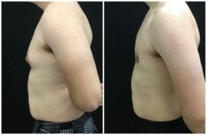 Male Breast Reduction - Before And After - Gynecomastia - Fairfax and Manassas VA