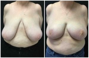 Breast Reduction Before And After - Fairfax and Manassas VA