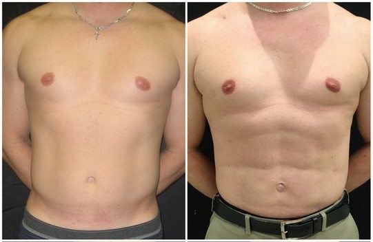 2116a-abdominal-etching - Abdominal Etching - Before And After | Fairfax and Manassas VA
