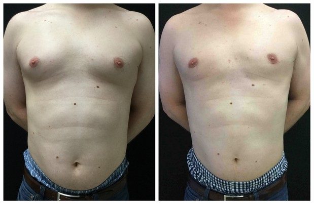 21214a-male-breast-reduction - Male Breast Reduction - Before And After - Gynecomastia - Fairfax and Manassas VA