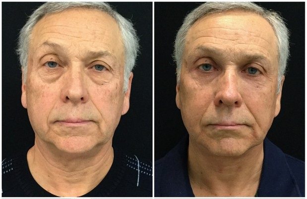 21214a56fda6922c259-eyelid-lift-upper-and-lower - Upper and Lower Eyelid Lift - Before And After - Fairfax and Manassas VA
