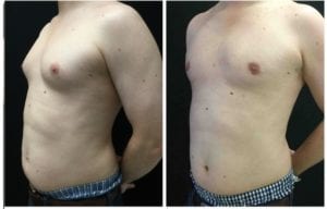 21214b-male-breast-reduction - Male Breast Reduction - Before And After - Gynecomastia - Fairfax and Manassas VA