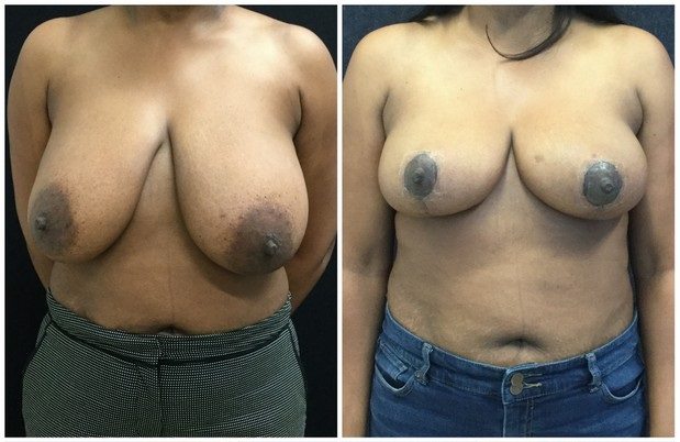21373a-breast-reduction - Breast Reduction Before And After - Fairfax and Manassas VA
