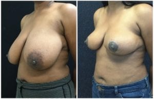 21373b-breast-reduction - Breast Reduction Before And After - Fairfax and Manassas VA