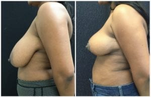 Breast Reduction Before And After - Fairfax and Manassas VA