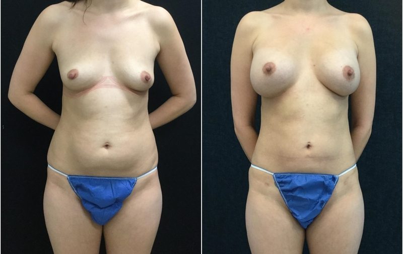 21425a-liposuction - Liposuction - Before And After - Fairfax and Manassas VA