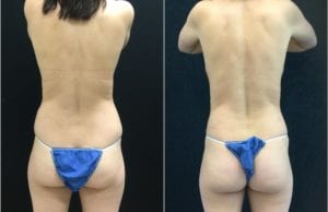 21425b-liposuction - Liposuction - Before And After - Fairfax and Manassas VA