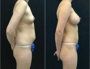 21425f-liposuction - Liposuction - Before And After - Fairfax and Manassas VA