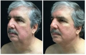 Mini Facelift - Before And After | Fairfax and Manassas VA