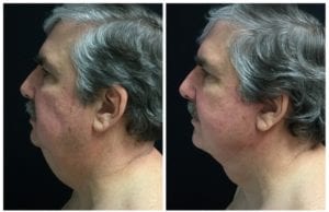 Mini Facelift - Before And After | Fairfax and Manassas VA