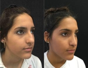 22327oblique-rhinoplasty-for-women - Rhinoplasty For Women - Before And After | Fairfax and Manassas VA