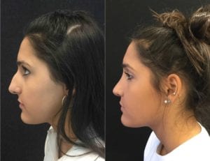 22327side-rhinoplasty-for-women - Rhinoplasty For Women - Before And After | Fairfax and Manassas VA