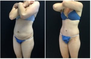 22384b-tummy-tuck-abdominoplasty - Tummy Tuck & Abdominoplasty - Before And After - Fairfax and Manassas VA