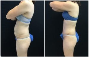 22384c-tummy-tuck-abdominoplasty - Tummy Tuck & Abdominoplasty - Before And After - Fairfax and Manassas VA