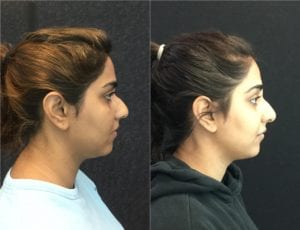 22596-20170317_side3-non-surgical-rhinoplasty - Non-Surgical Rhinoplasty - Before And After | Fairfax and Manassas VA