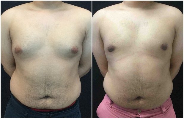 22632a-male-breast-reduction - Male Breast Reduction - Before And After - Gynecomastia - Fairfax and Manassas VA