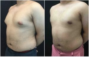 22632b-male-breast-reduction - Male Breast Reduction - Before And After - Gynecomastia - Fairfax and Manassas VA