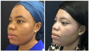 23189b-non-surgical-rhinoplasty - Non-Surgical Rhinoplasty - Before And After | Fairfax and Manassas VA