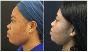 23189c-non-surgical-rhinoplasty - Non-Surgical Rhinoplasty - Before And After | Fairfax and Manassas VA