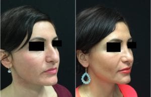 23588-20170515_Canvas1-rhinoplasty-for-women - Rhinoplasty For Women - Before And After | Fairfax and Manassas VA
