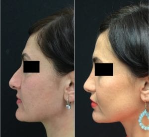 23588-20170515_Canvas3-rhinoplasty-for-women - Rhinoplasty For Women - Before And After | Fairfax and Manassas VA