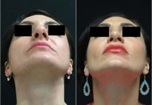 23588-20170515_Canvas4-rhinoplasty-for-women - Rhinoplasty For Women - Before And After | Fairfax and Manassas VA