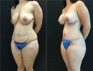 24918-20170612_Oblique-Canvas-mommy-makeover - Mommy Makeover - Before And After - Fairfax and Manassas VA