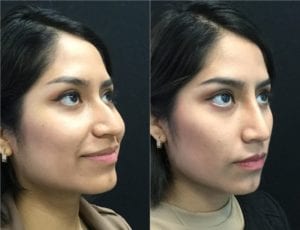 Non-Surgical Rhinoplasty - Before And After | Fairfax and Manassas VA