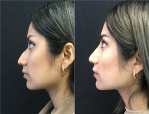 25137-20170522_Side-Canvas-non-surgical-rhinoplasty - Non-Surgical Rhinoplasty - Before And After | Fairfax and Manassas VA
