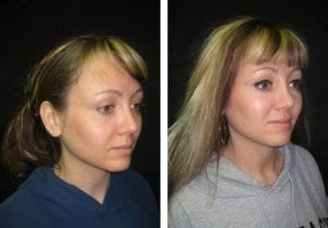 2727-side-view-non-surgical-rhinoplasty - Non-Surgical Rhinoplasty - Before And After | Fairfax and Manassas VA