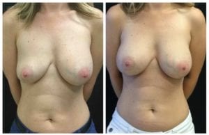 Breast Implant Exchange - Before And After - Fairfax and Manassas VA