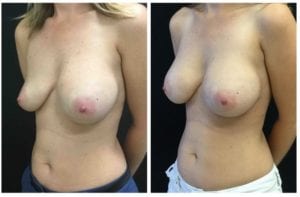2867b-breast-implant-exchange - Breast Implant Exchange - Before And After - Fairfax and Manassas VA