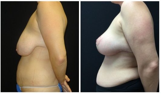 2934c-breast-lift - Breast Lift - Mastopexy Before And After
