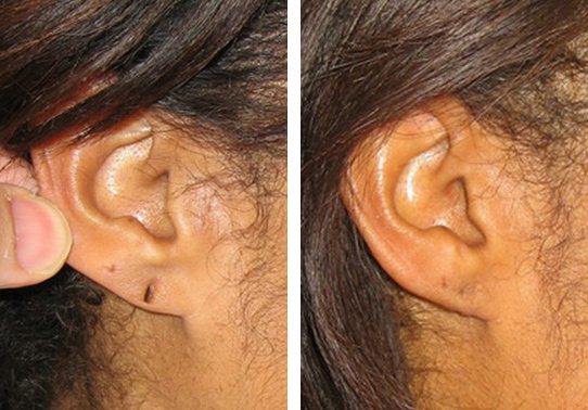 3-torn-earlobe-repair - Torn Earlobe Repair - Before And After | Fairfax and Manassas VA
