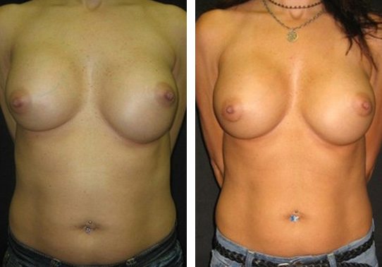3144-front-breast-implant-exchange - Breast Implant Exchange - Before And After - Fairfax and Manassas VA