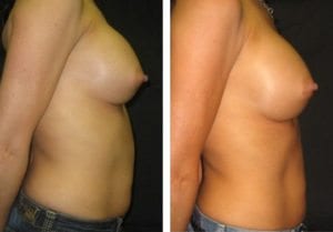 3144-side-breast-implant-exchange - Breast Implant Exchange - Before And After - Fairfax and Manassas VA
