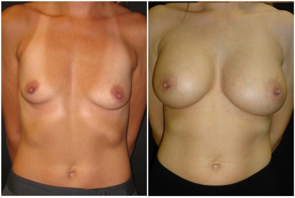 3305a53344ac8c9ee9-breast-augmentation - Breast Augmentation Before And After - Fairfax and Manassas VA