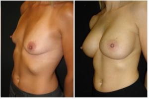 3305b53344ac9d685a-breast-augmentation - Breast Augmentation Before And After - Fairfax and Manassas VA