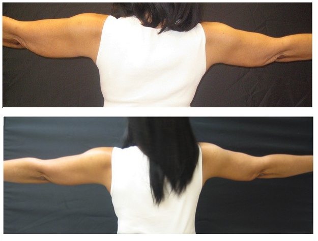 4323c-arm-lifts - Arm Lifts - Before And After - Fairfax and Manassas VA