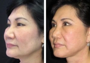 4582-Side-facelift - Facelift - Before And After Photos - Fairfax and Manassas VA
