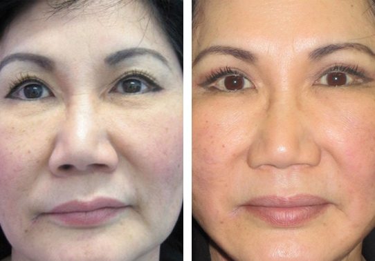 4582-Web-eyelid-lifts-upper - Upper Eyelid Lift - Before And After Photos - Fairfax and Manassas VA