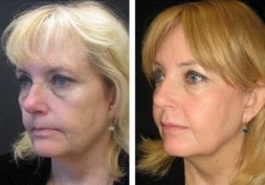 4697-sideview527114eb8acf8-non-surgical-facelift - Non-Surgical Facelift - Patient 1 - Before & After 2 | Fairfax and Manassas, VA