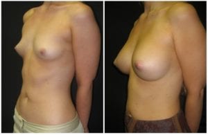 4782b-breast-augmentation - Breast Augmentation Before And After - Fairfax and Manassas VA