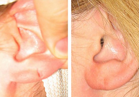 5-torn-earlobe-repair - Torn Earlobe Repair - Before And After | Fairfax and Manassas VA