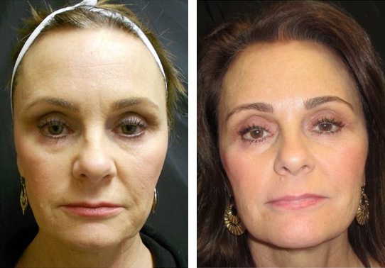 5318-Front-ultherapy-lift - Ultherapy Lift - Before And After | Fairfax and Manassas VA